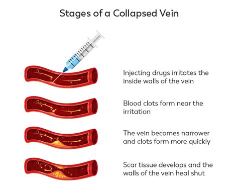 vein hard after blood test|what to expect after a blown vein.